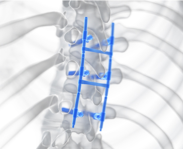 Life After Spinal Fusion Surgery