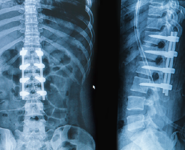spinal fusion conjoins vertebrae 