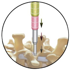 METRx Microdiscectomy System