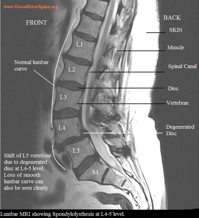 MRI of Spine - Spondylolisthesis