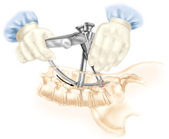 percutaneous disc surgery image