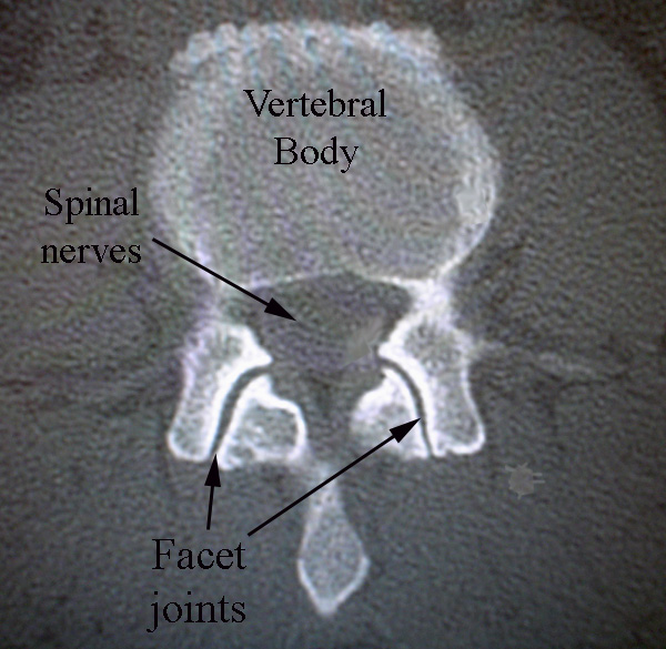 Normal Facet Joint - Texas Spine Center
